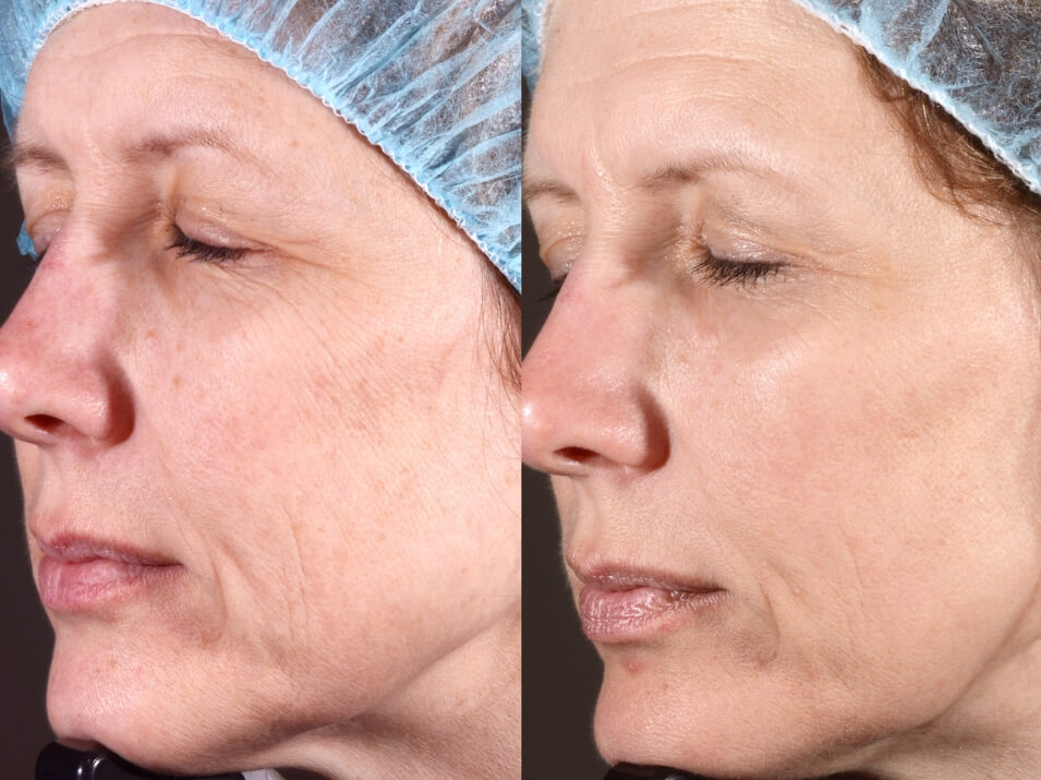 Laser facial before and after