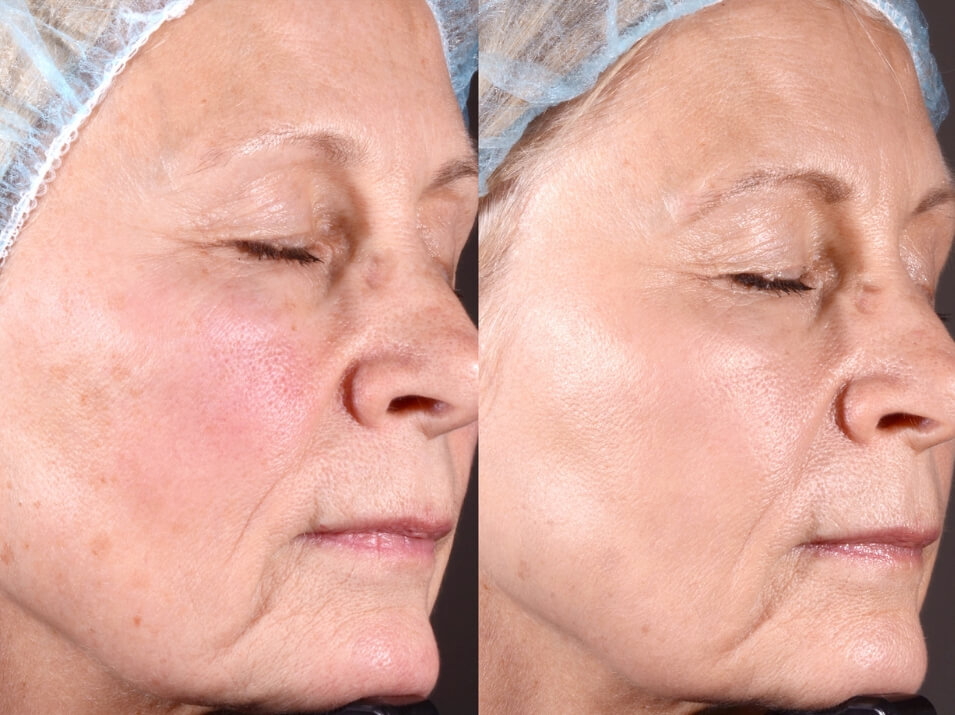 Laser facial before and after