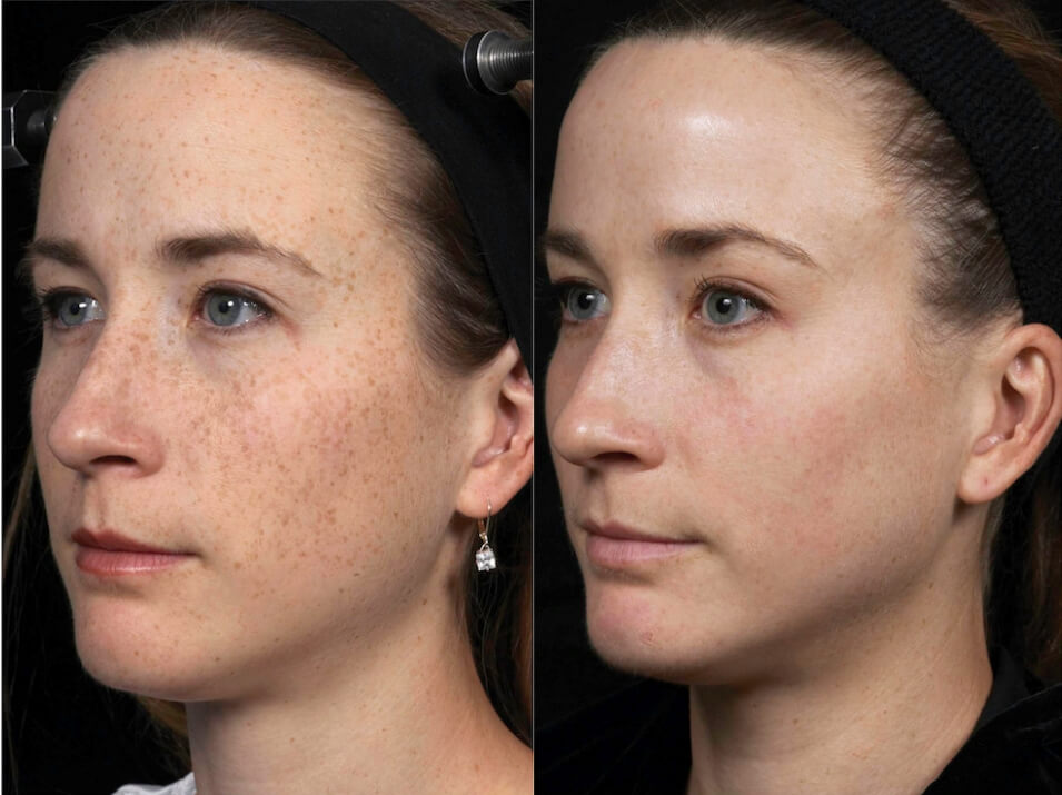 Laser Facial before and after Emerge Fractional Laser Results