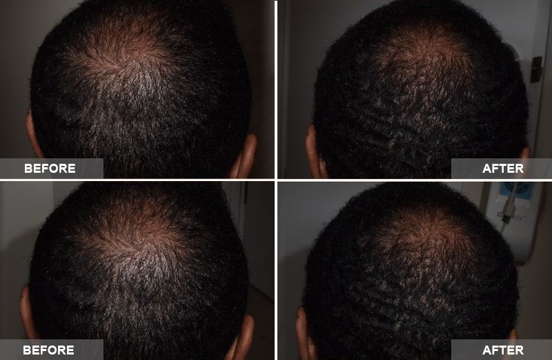 PRP Hair Restoration: Hair Loss + Thinning Hair Treatment